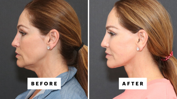 The Trending Procedure That Can Restore Your 25-Year-Old Jawline—With Before and After Photos